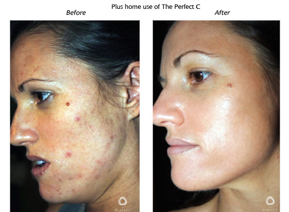 PDPeel_Model-2 Chemical Peels Treatment