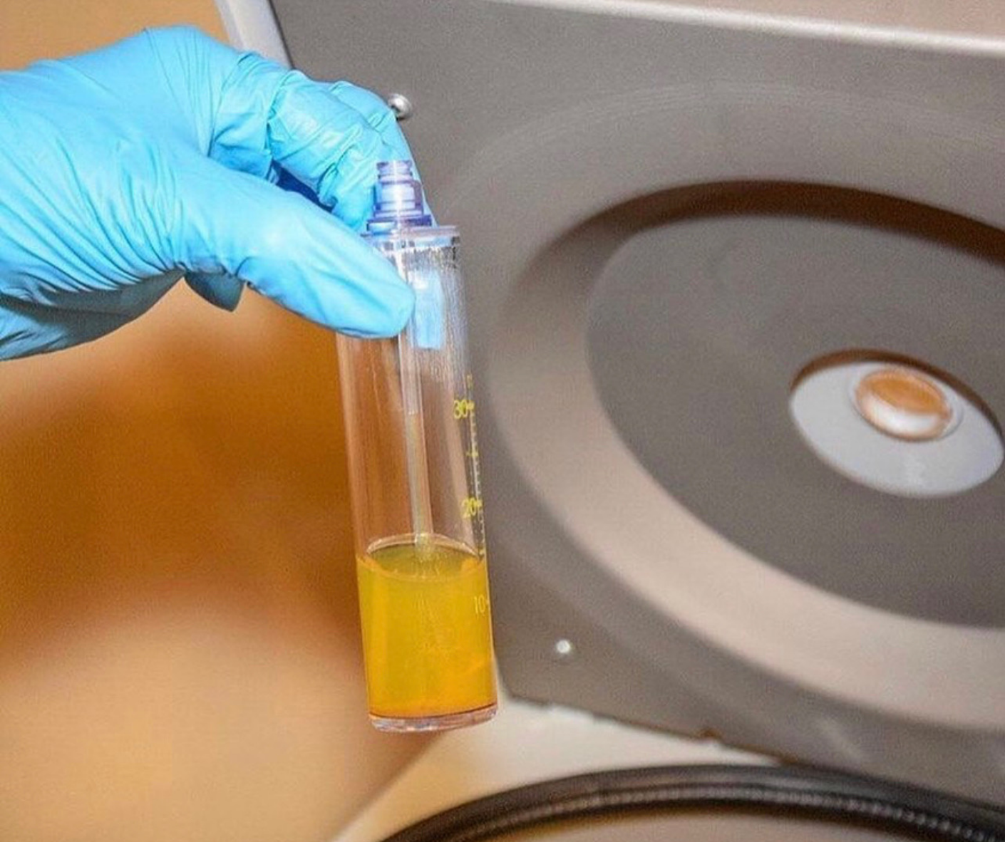 platelet rich plasma sample